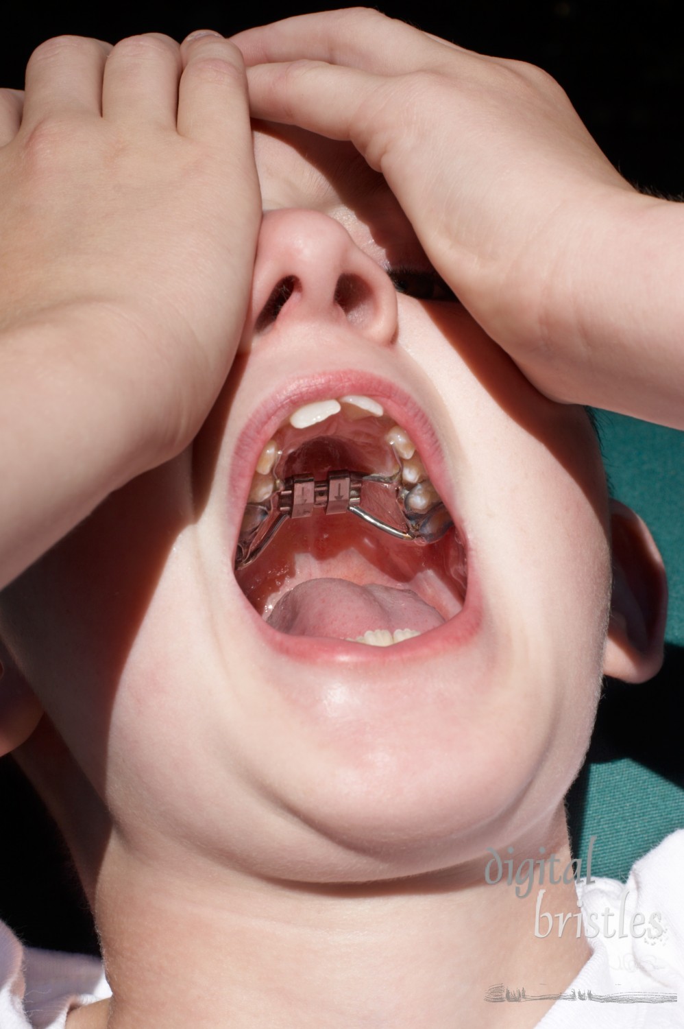 Boy preparing to have his palatal expander adjusted