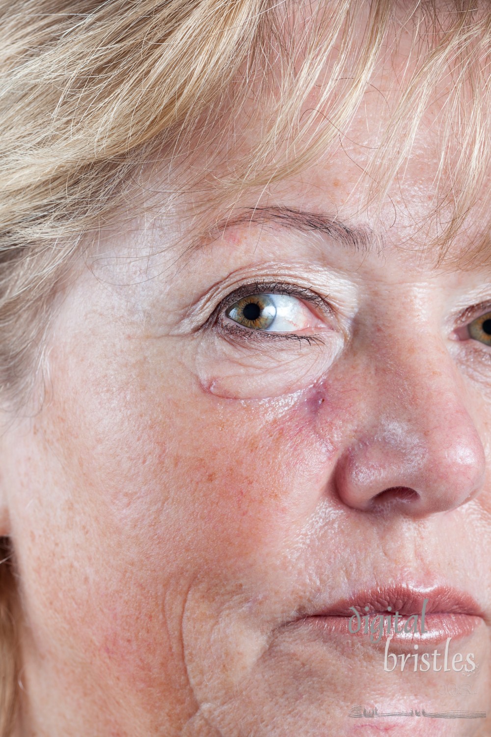 Mature woman with gradually fading scar three weeks after Mohs surgery for Basal Cell Carcinoma - closeup