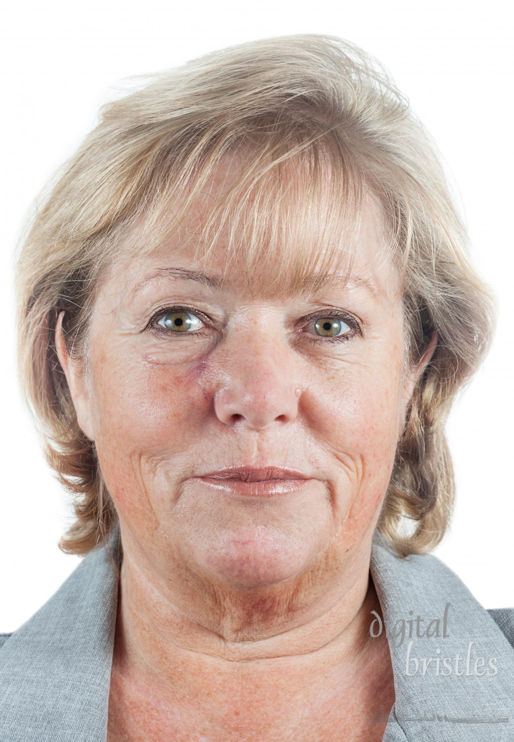 Mature woman with gradually fading scar three weeks after Mohs surgery for Basal Cell Carcinoma