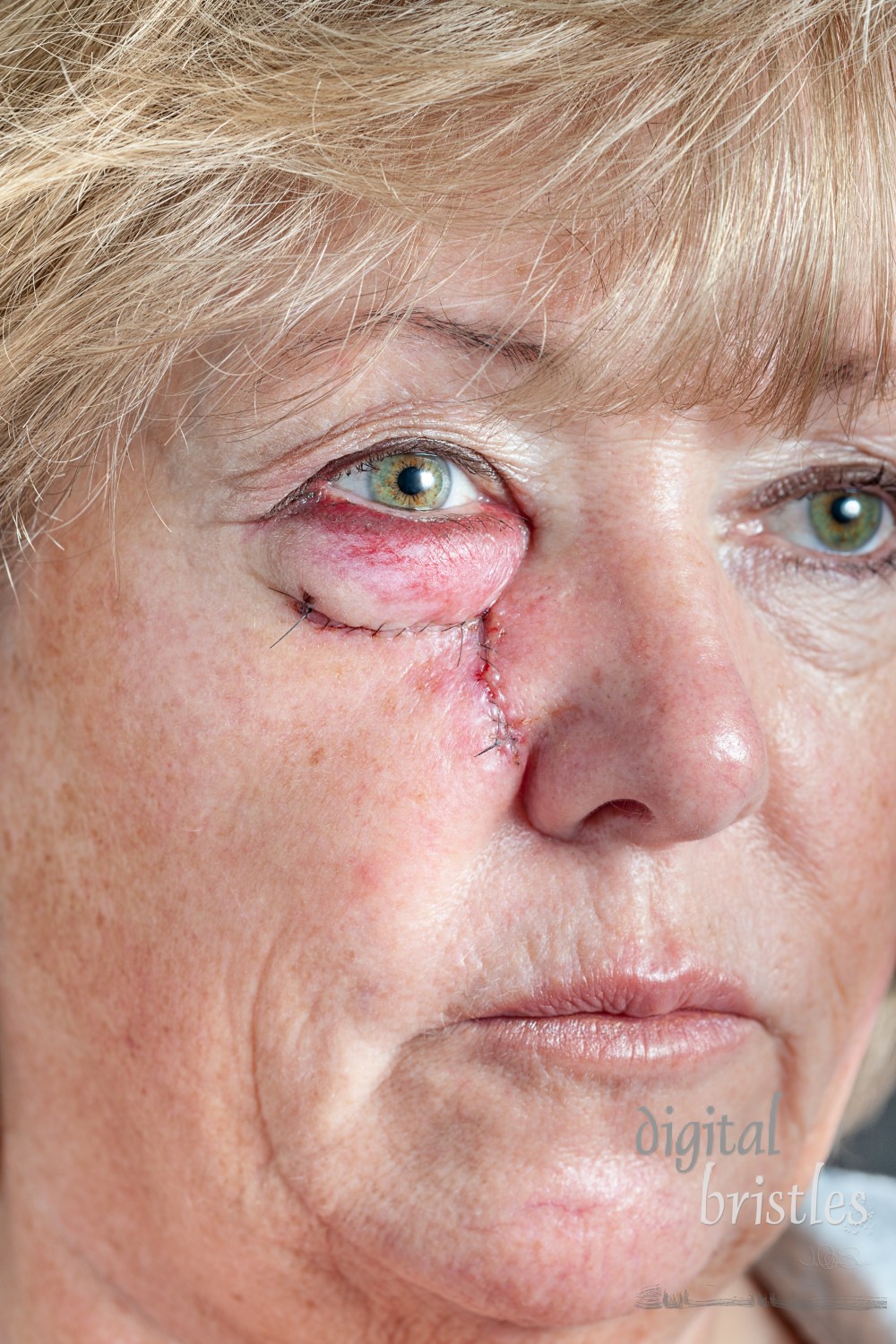 Mature woman with stitched cheek one day after Mohs surgery for Basal Cell Carcinoma - closeup