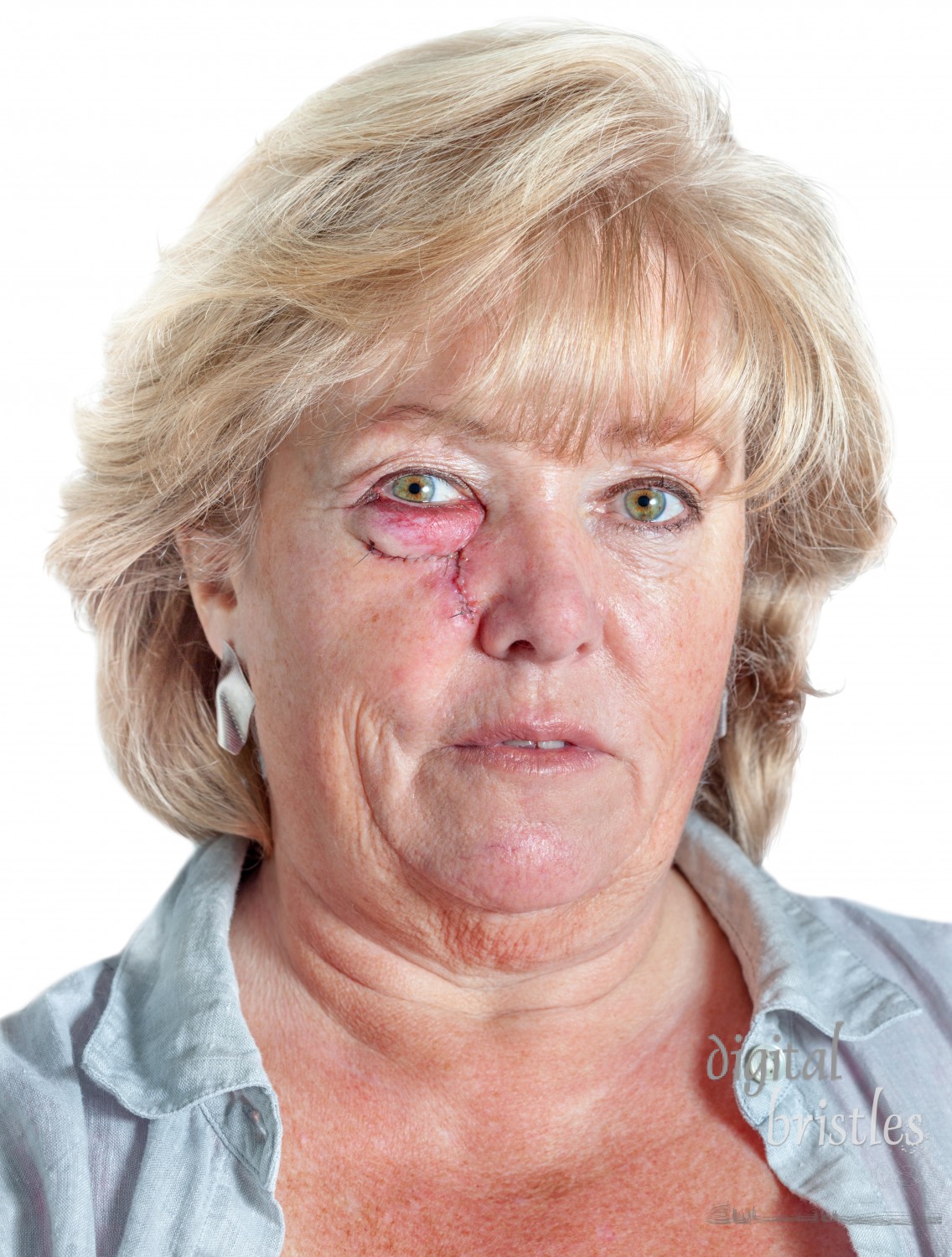 Mature woman with stitched cheek one day after Mohs surgery for Basal Cell Carcinoma