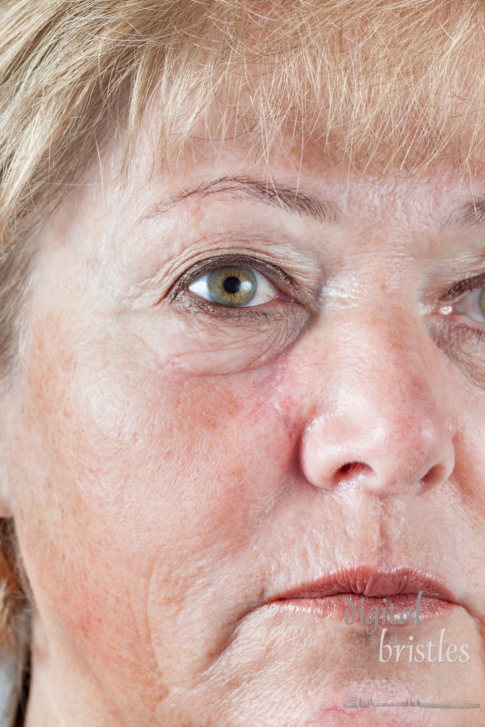 Mature woman with gradually fading scar one month after Mohs surgery for Basal Cell Carcinoma - closeup