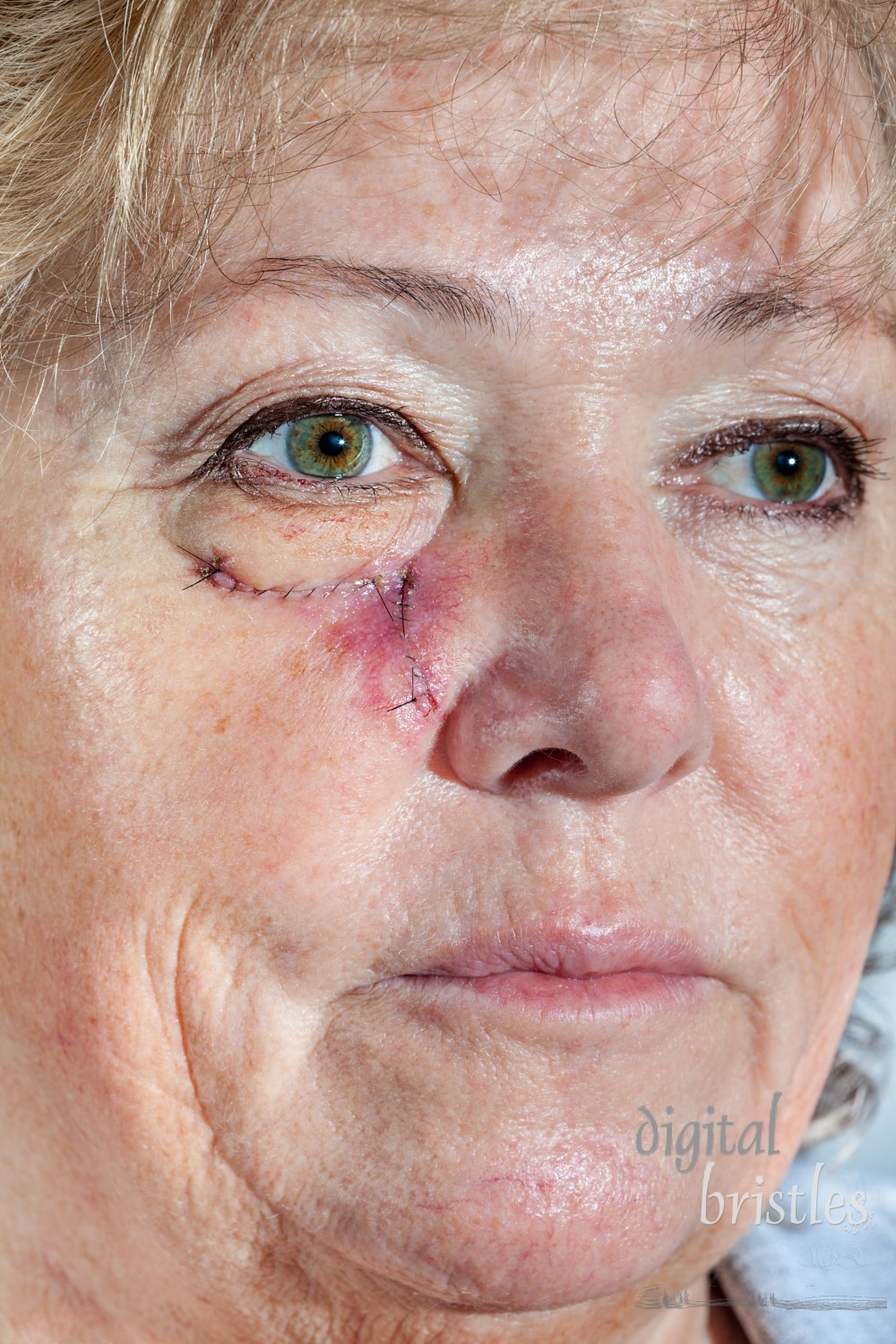 Mature woman with stitched cheek one week after Mohs surgery for Basal Cell Carcinoma - closeup