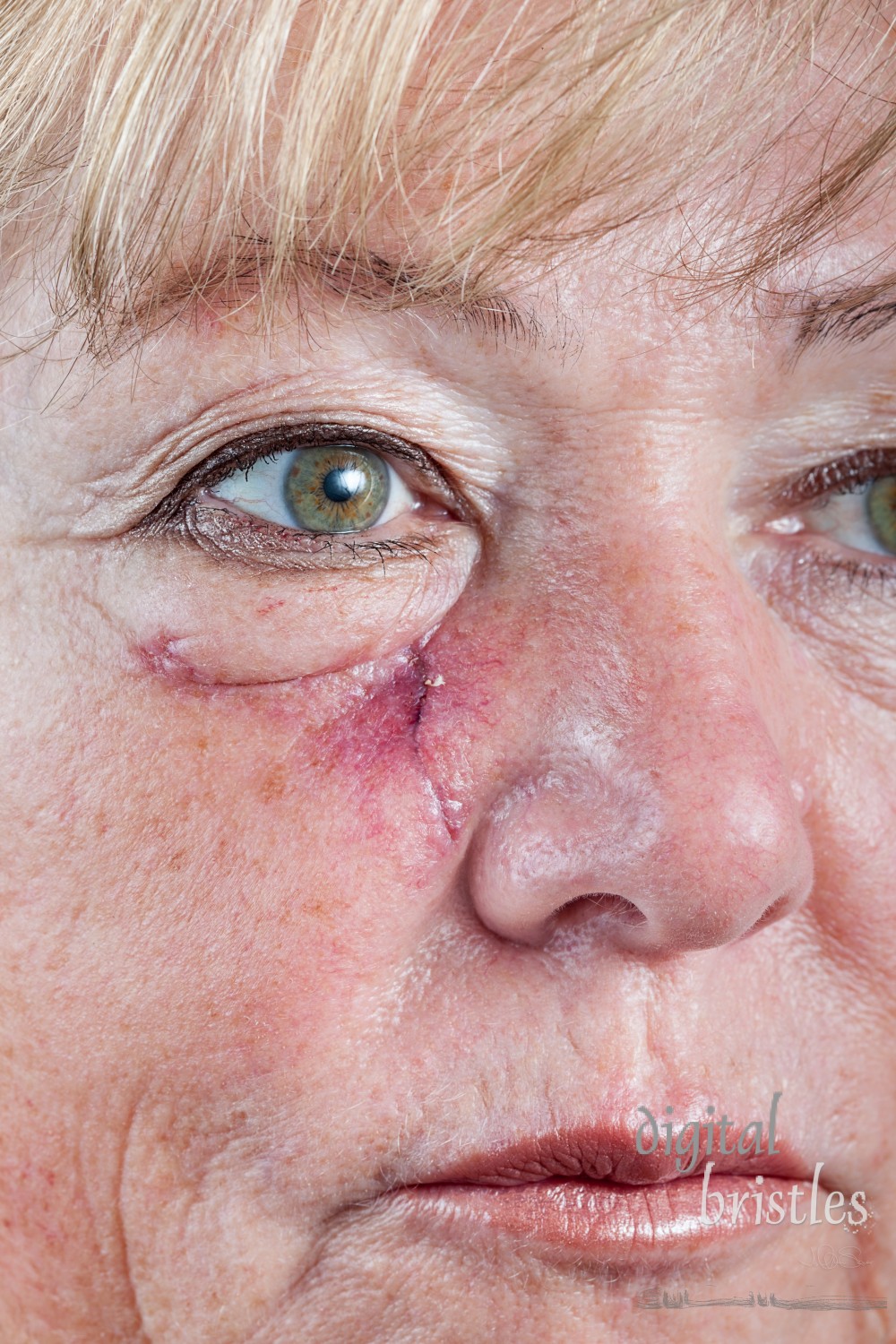 Mature woman with scar and spitting suture one week after Mohs surgery for Basal Cell Carcinoma - closeup