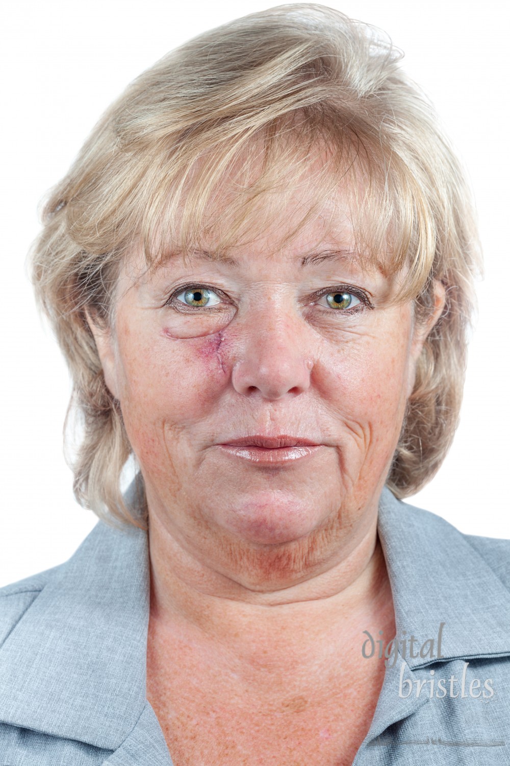 Mature woman with scar and spitting suture one week after Mohs surgery for Basal Cell Carcinoma