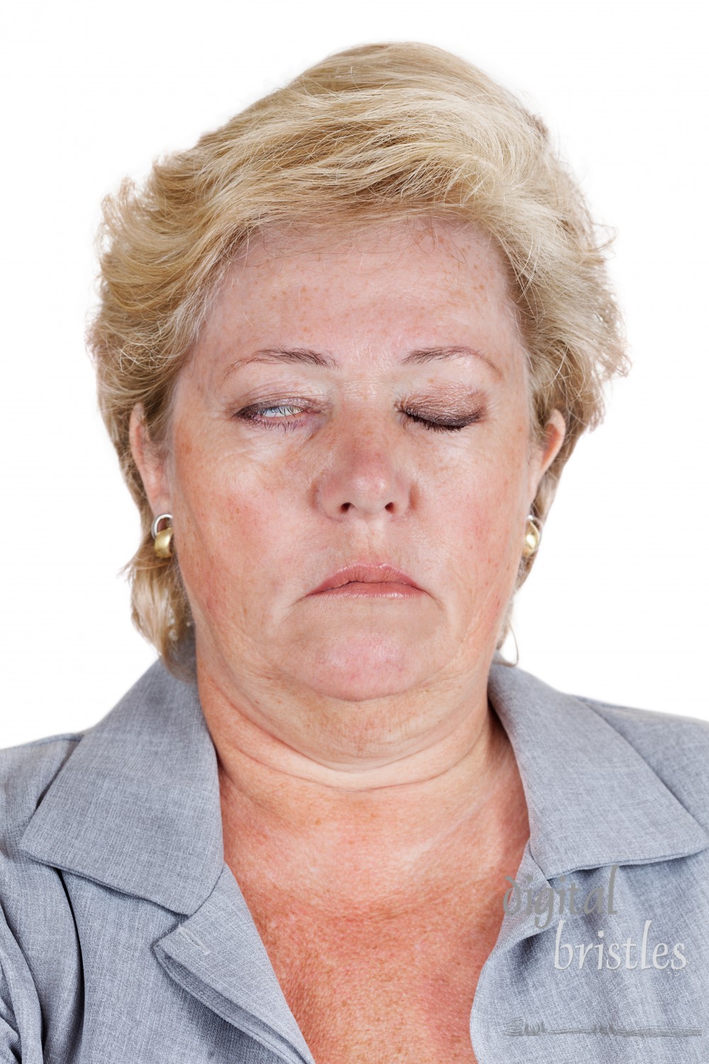 Mature woman with Bell's Palsy unable to fully close her right eye